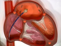 Ученые открыли способ защитить мозг от последствий ишемии