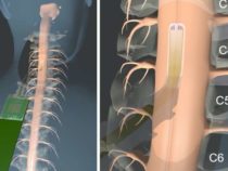Создан массив микроэлектродов, который обеспечивает точные 2D-карты электрофизиологии спинного мозга во время операции